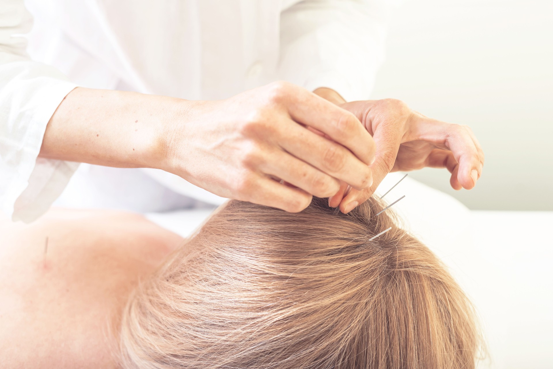 Woman on acupuncture