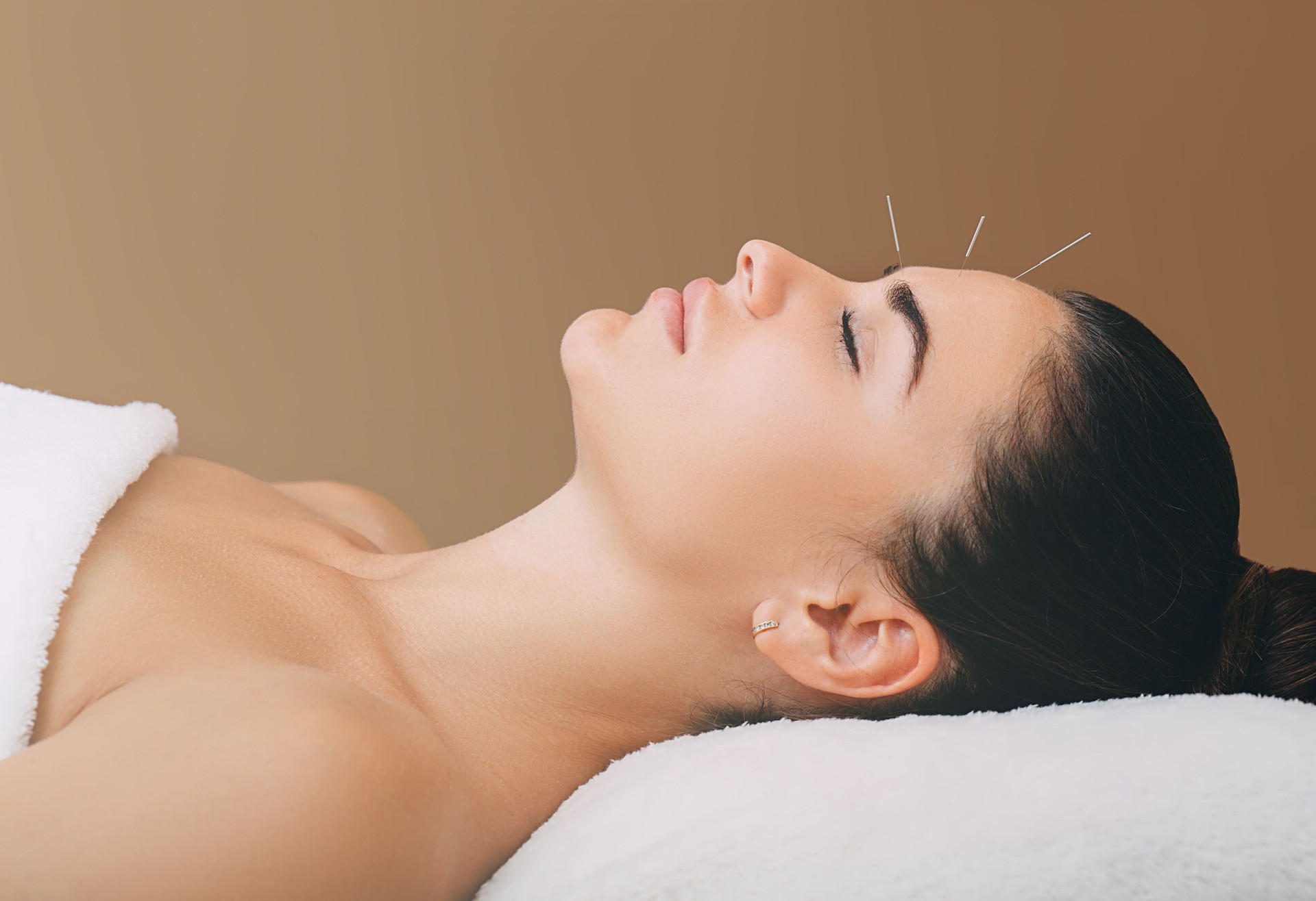 beautiful woman has a headache. Acupuncture treatment for migraines. Needles in the forehead of a woman close-up on a brown background